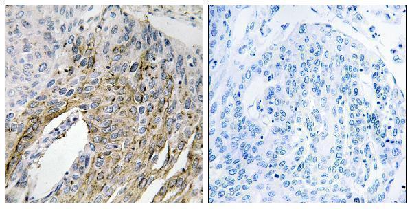 Immunohistochemistry analysis of paraffin-embedded human lung carcinoma tissue, using LONP2 Antibody
