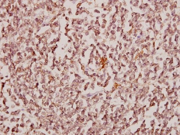 Immunohistochemistry (IHC) analyzes of CBX6 (K18) pAb in paraffin-embedded human tonsil carcinoma tissue at 1:50