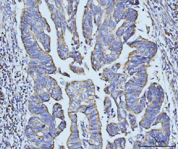 Figure 3. IHC analysis of BZW2 using anti-BZW2 antibody (A11832-1). BZW2 was detected in a paraffin-embedded section of human gastric adenocarcinoma tissue. Heat mediated antigen retrieval was performed in EDTA buffer (pH 8.0, epitope retrieval solution). The tissue section was blocked with 10% goat serum. The tissue section was then incubated with 2 microg/ml rabbit anti-BZW2 Antibody (A11832-1) overnight at 4°C. Biotinylated goat anti-rabbit IgG was used as secondary antibody and incubated for 30 minutes at 37°C. The tissue section was developed using Strepavidin-Biotin-Complex (SABC) (Catalog # SA1022) with DAB as the chromogen.