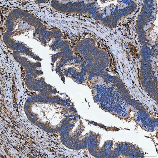 Figure 2. IHC analysis of SEMA4F using anti-SEMA4F antibody (A11873-2). SEMA4F was detected in a paraffin-embedded section of human colon adenocarcinoma tissue. Heat mediated antigen retrieval was performed in EDTA buffer (pH 8.0, epitope retrieval solution). The tissue section was blocked with 10% goat serum. The tissue section was then incubated with 2 microg/ml rabbit anti-SEMA4F Antibody (A11873-2) overnight at 4°C. Peroxidase Conjugated Goat Anti-rabbit IgG was used as secondary antibody and incubated for 30 minutes at 37°C. The tissue section was developed using HRP Conjugated Rabbit IgG Super Vision Assay Kit (Catalog # SV0002) with DAB as the chromogen. Figure 2. IHC analysis of SEMA4F using anti-SEMA4F antibody (A11873-2). SEMA4F was detected in a paraffin-embedded section of human colon adenocarcinoma tissue. Heat mediated antigen retrieval was performed in EDTA buffer (pH 8.0, epitope retrieval solution). The tissue section was blocked with 10% goat serum. The tissue section was then incubated with 2 microg/ml rabbit anti-SEMA4F Antibody (A11873-2) overnight at 4°C. Peroxidase Conjugated Goat Anti-rabbit IgG was used as secondary antibody and incubated for 30 minutes at 37°C. The tissue section was developed using HRP Conjugated Rabbit IgG Super Vision Assay Kit (Catalog # SV0002) with DAB as the chromogen.