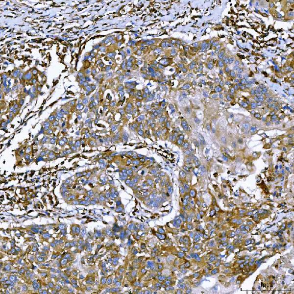 Figure 3. IHC analysis of SEMA4F using anti-SEMA4F antibody (A11873-2). SEMA4F was detected in a paraffin-embedded section of human larynx squamous cell carcinoma tissue. Heat mediated antigen retrieval was performed in EDTA buffer (pH 8.0, epitope retrieval solution). The tissue section was blocked with 10% goat serum. The tissue section was then incubated with 2 microg/ml rabbit anti-SEMA4F Antibody (A11873-2) overnight at 4°C. Peroxidase Conjugated Goat Anti-rabbit IgG was used as secondary antibody and incubated for 30 minutes at 37°C. The tissue section was developed using HRP Conjugated Rabbit IgG Super Vision Assay Kit (Catalog # SV0002) with DAB as the chromogen. Figure 3. IHC analysis of SEMA4F using anti-SEMA4F antibody (A11873-2). SEMA4F was detected in a paraffin-embedded section of human larynx squamous cell carcinoma tissue. Heat mediated antigen retrieval was performed in EDTA buffer (pH 8.0, epitope retrieval solution). The tissue section was blocked with 10% goat serum. The tissue section was then incubated with 2 microg/ml rabbit anti-SEMA4F Antibody (A11873-2) overnight at 4°C. Peroxidase Conjugated Goat Anti-rabbit IgG was used as secondary antibody and incubated for 30 minutes at 37°C. The tissue section was developed using HRP Conjugated Rabbit IgG Super Vision Assay Kit (Catalog # SV0002) with DAB as the chromogen.