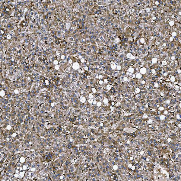 Figure 4. IHC analysis of SEMA4F using anti-SEMA4F antibody (A11873-2). SEMA4F was detected in a paraffin-embedded section of human liver cancer tissue. Heat mediated antigen retrieval was performed in EDTA buffer (pH 8.0, epitope retrieval solution). The tissue section was blocked with 10% goat serum. The tissue section was then incubated with 2 microg/ml rabbit anti-SEMA4F Antibody (A11873-2) overnight at 4°C. Peroxidase Conjugated Goat Anti-rabbit IgG was used as secondary antibody and incubated for 30 minutes at 37°C. The tissue section was developed using HRP Conjugated Rabbit IgG Super Vision Assay Kit (Catalog # SV0002) with DAB as the chromogen. Figure 4. IHC analysis of SEMA4F using anti-SEMA4F antibody (A11873-2). SEMA4F was detected in a paraffin-embedded section of human liver cancer tissue. Heat mediated antigen retrieval was performed in EDTA buffer (pH 8.0, epitope retrieval solution). The tissue section was blocked with 10% goat serum. The tissue section was then incubated with 2 microg/ml rabbit anti-SEMA4F Antibody (A11873-2) overnight at 4°C. Peroxidase Conjugated Goat Anti-rabbit IgG was used as secondary antibody and incubated for 30 minutes at 37°C. The tissue section was developed using HRP Conjugated Rabbit IgG Super Vision Assay Kit (Catalog # SV0002) with DAB as the chromogen.