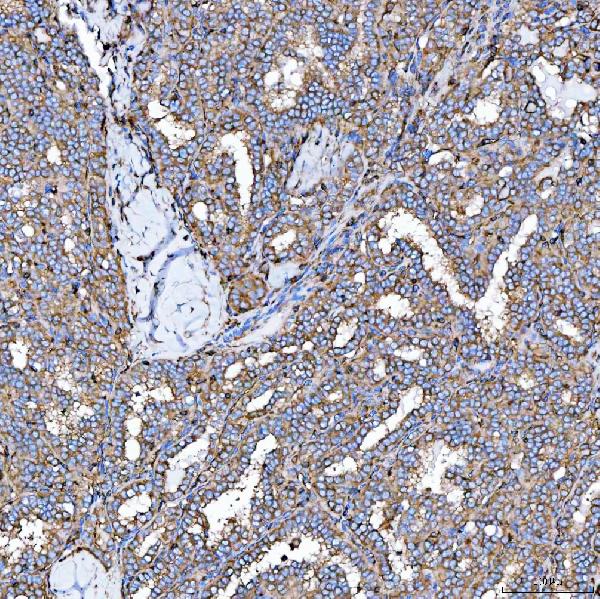 Figure 6. IHC analysis of SEMA4F using anti-SEMA4F antibody (A11873-2). SEMA4F was detected in a paraffin-embedded section of human thyroid cancer tissue. Heat mediated antigen retrieval was performed in EDTA buffer (pH 8.0, epitope retrieval solution). The tissue section was blocked with 10% goat serum. The tissue section was then incubated with 2 microg/ml rabbit anti-SEMA4F Antibody (A11873-2) overnight at 4°C. Peroxidase Conjugated Goat Anti-rabbit IgG was used as secondary antibody and incubated for 30 minutes at 37°C. The tissue section was developed using HRP Conjugated Rabbit IgG Super Vision Assay Kit (Catalog # SV0002) with DAB as the chromogen. Figure 6. IHC analysis of SEMA4F using anti-SEMA4F antibody (A11873-2). SEMA4F was detected in a paraffin-embedded section of human thyroid cancer tissue. Heat mediated antigen retrieval was performed in EDTA buffer (pH 8.0, epitope retrieval solution). The tissue section was blocked with 10% goat serum. The tissue section was then incubated with 2 microg/ml rabbit anti-SEMA4F Antibody (A11873-2) overnight at 4°C. Peroxidase Conjugated Goat Anti-rabbit IgG was used as secondary antibody and incubated for 30 minutes at 37°C. The tissue section was developed using HRP Conjugated Rabbit IgG Super Vision Assay Kit (Catalog # SV0002) with DAB as the chromogen.