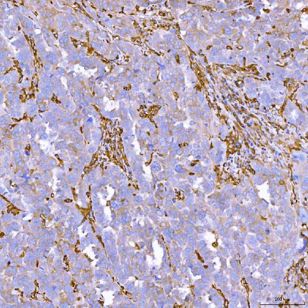 Figure 8. IHC analysis of SEMA4F using anti-SEMA4F antibody (A11873-2). SEMA4F was detected in a paraffin-embedded section of human ovarian serous cancer tissue. Heat mediated antigen retrieval was performed in EDTA buffer (pH 8.0, epitope retrieval solution). The tissue section was blocked with 10% goat serum. The tissue section was then incubated with 2 microg/ml rabbit anti-SEMA4F Antibody (A11873-2) overnight at 4°C. Peroxidase Conjugated Goat Anti-rabbit IgG was used as secondary antibody and incubated for 30 minutes at 37°C. The tissue section was developed using HRP Conjugated Rabbit IgG Super Vision Assay Kit (Catalog # SV0002) with DAB as the chromogen. Figure 8. IHC analysis of SEMA4F using anti-SEMA4F antibody (A11873-2). SEMA4F was detected in a paraffin-embedded section of human ovarian serous cancer tissue. Heat mediated antigen retrieval was performed in EDTA buffer (pH 8.0, epitope retrieval solution). The tissue section was blocked with 10% goat serum. The tissue section was then incubated with 2 microg/ml rabbit anti-SEMA4F Antibody (A11873-2) overnight at 4°C. Peroxidase Conjugated Goat Anti-rabbit IgG was used as secondary antibody and incubated for 30 minutes at 37°C. The tissue section was developed using HRP Conjugated Rabbit IgG Super Vision Assay Kit (Catalog # SV0002) with DAB as the chromogen.