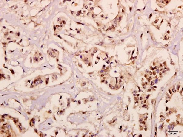 Immunohistochemistry (IHC) analyzes of NDUFB10 (E95) pAb in paraffin-embedded human breast carcinoma tissue at 1:50
