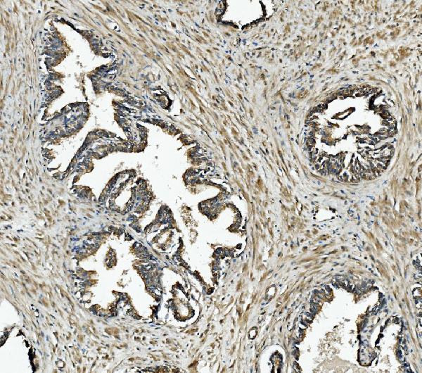 Figure 4. IHC analysis of NDUFB10 using anti-NDUFB10 antibody (A11886-3). NDUFB10 was detected in paraffin-embedded section of human prostate cancer tissue. Heat mediated antigen retrieval was performed in EDTA buffer (pH8.0, epitope retrieval solution). The tissue section was blocked with 10% goat serum. The tissue section was then incubated with 2microg/ml rabbit anti-NDUFB10 Antibody (A11886-3) overnight at 4°C. Biotinylated goat anti-rabbit IgG was used as secondary antibody and incubated for 30 minutes at 37°C. The tissue section was developed using Strepavidin-Biotin-Complex (SABC) (Catalog # SA1022) with DAB as the chromogen.