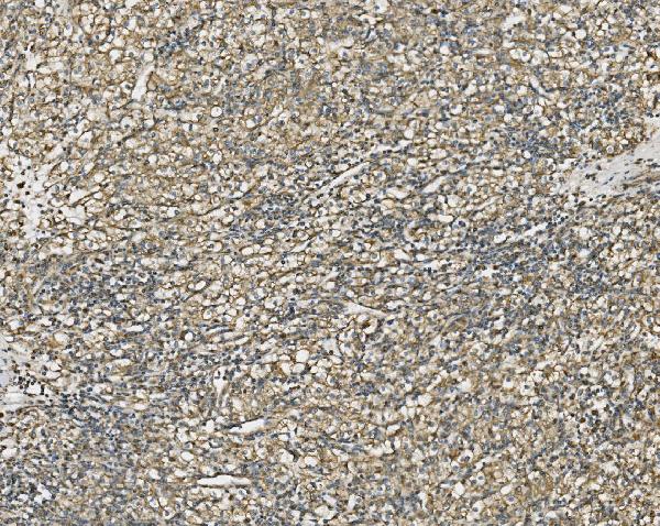 Figure 5. IHC analysis of NDUFB10 using anti-NDUFB10 antibody (A11886-3). NDUFB10 was detected in paraffin-embedded section of human gastric cancer tissue. Heat mediated antigen retrieval was performed in EDTA buffer (pH8.0, epitope retrieval solution). The tissue section was blocked with 10% goat serum. The tissue section was then incubated with 2microg/ml rabbit anti-NDUFB10 Antibody (A11886-3) overnight at 4°C. Biotinylated goat anti-rabbit IgG was used as secondary antibody and incubated for 30 minutes at 37°C. The tissue section was developed using Strepavidin-Biotin-Complex (SABC) (Catalog # SA1022) with DAB as the chromogen.