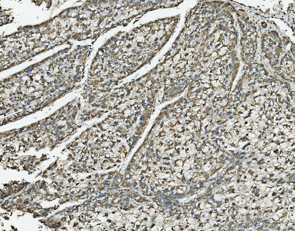 Figure 6. IHC analysis of NDUFB10 using anti-NDUFB10 antibody (A11886-3). NDUFB10 was detected in paraffin-embedded section of human liver cancer tissue. Heat mediated antigen retrieval was performed in EDTA buffer (pH8.0, epitope retrieval solution). The tissue section was blocked with 10% goat serum. The tissue section was then incubated with 2microg/ml rabbit anti-NDUFB10 Antibody (A11886-3) overnight at 4°C. Biotinylated goat anti-rabbit IgG was used as secondary antibody and incubated for 30 minutes at 37°C. The tissue section was developed using Strepavidin-Biotin-Complex (SABC) (Catalog # SA1022) with DAB as the chromogen.