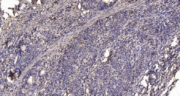 Immunohistochemical analysis of paraffin-embedded human Gastric adenocarcinoma
