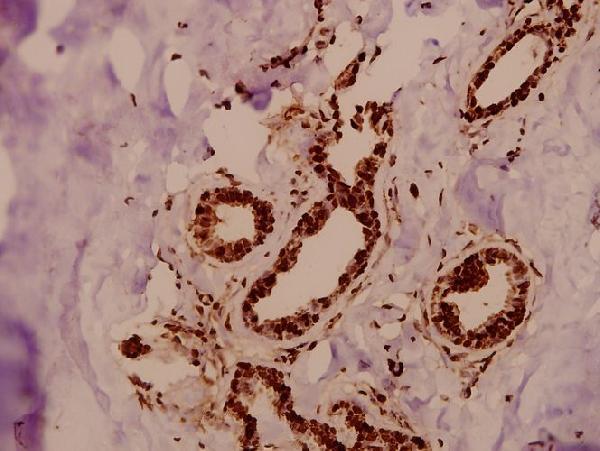 Immunohistochemistry (IHC) analyzes of TFIIIC102 (E131) pAb in paraffin-embedded human breast carcinoma tissue at 1:50