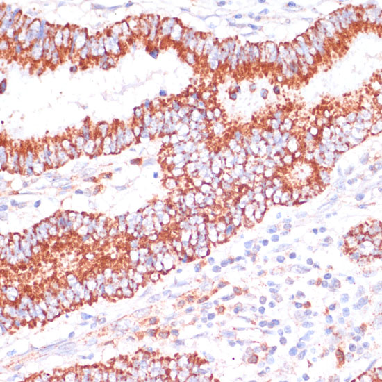 Immunohistochemistry of paraffin-embedded human colon carcinoma using ENTPD6 antibody  at dilution of 1:100 
