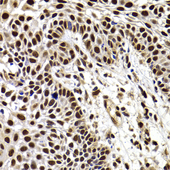 Immunohistochemistry of paraffin-embedded human well-differentiated squamous skin carcinoma using HIRIP3 antibody  at dilution of 1:100 