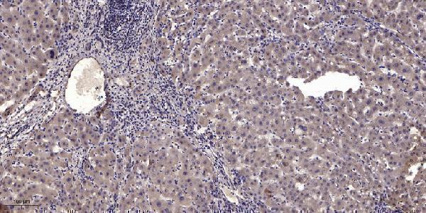 Immunohistochemical analysis of paraffin-embedded human liver cancer