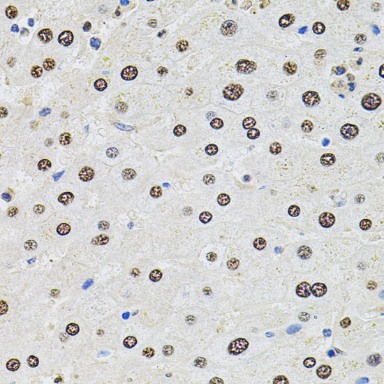 Immunohistochemistry of paraffin-embedded human liver damage using U2SURP antibody  at dilution of 1:100 