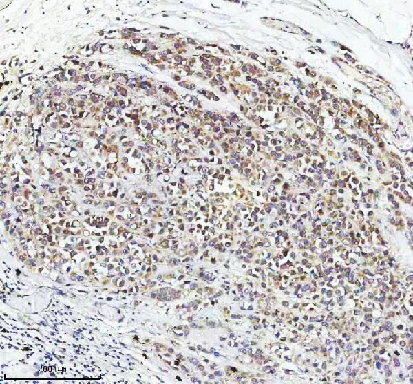 Figure 2. IHC analysis of FAM40B/STRIP2 using anti-FAM40B/STRIP2 antibody (A12139). FAM40B/STRIP2 was detected in a paraffin-embedded section of human breast cancer tissue. Heat mediated antigen retrieval was performed in EDTA buffer (pH 8.0, epitope retrieval solution). The tissue section was blocked with 10% goat serum. The tissue section was then incubated with 2 microg/ml rabbit anti-FAM40B/STRIP2 Antibody (A12139) overnight at 4°C. Peroxidase Conjugated Goat Anti-rabbit IgG was used as secondary antibody and incubated for 30 minutes at 37°C. The tissue section was developed using HRP Conjugated Rabbit IgG Super Vision Assay Kit (Catalog # SV0002) with DAB as the chromogen. Figure 2. IHC analysis of FAM40B/STRIP2 using anti-FAM40B/STRIP2 antibody (A12139). FAM40B/STRIP2 was detected in a paraffin-embedded section of human breast cancer tissue. Heat mediated antigen retrieval was performed in EDTA buffer (pH 8.0, epitope retrieval solution). The tissue section was blocked with 10% goat serum. The tissue section was then incubated with 2 microg/ml rabbit anti-FAM40B/STRIP2 Antibody (A12139) overnight at 4°C. Peroxidase Conjugated Goat Anti-rabbit IgG was used as secondary antibody and incubated for 30 minutes at 37°C. The tissue section was developed using HRP Conjugated Rabbit IgG Super Vision Assay Kit (Catalog # SV0002) with DAB as the chromogen.