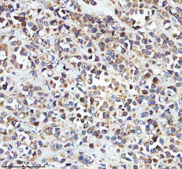 Figure 3. IHC analysis of FAM40B/STRIP2 using anti-FAM40B/STRIP2 antibody (A12139). FAM40B/STRIP2 was detected in a paraffin-embedded section of human breast cancer tissue. Heat mediated antigen retrieval was performed in EDTA buffer (pH 8.0, epitope retrieval solution). The tissue section was blocked with 10% goat serum. The tissue section was then incubated with 2 microg/ml rabbit anti-FAM40B/STRIP2 Antibody (A12139) overnight at 4°C. Peroxidase Conjugated Goat Anti-rabbit IgG was used as secondary antibody and incubated for 30 minutes at 37°C. The tissue section was developed using HRP Conjugated Rabbit IgG Super Vision Assay Kit (Catalog # SV0002) with DAB as the chromogen. Figure 3. IHC analysis of FAM40B/STRIP2 using anti-FAM40B/STRIP2 antibody (A12139). FAM40B/STRIP2 was detected in a paraffin-embedded section of human breast cancer tissue. Heat mediated antigen retrieval was performed in EDTA buffer (pH 8.0, epitope retrieval solution). The tissue section was blocked with 10% goat serum. The tissue section was then incubated with 2 microg/ml rabbit anti-FAM40B/STRIP2 Antibody (A12139) overnight at 4°C. Peroxidase Conjugated Goat Anti-rabbit IgG was used as secondary antibody and incubated for 30 minutes at 37°C. The tissue section was developed using HRP Conjugated Rabbit IgG Super Vision Assay Kit (Catalog # SV0002) with DAB as the chromogen.