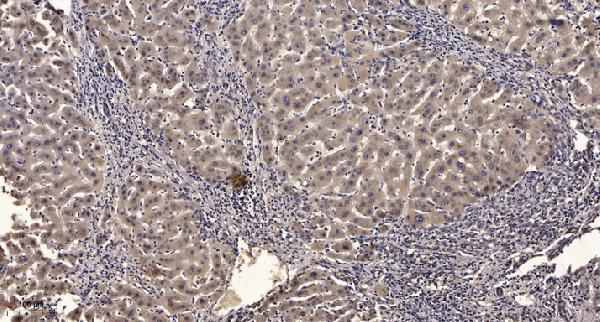 Immunohistochemical analysis of paraffin-embedded human liver cancer