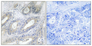 Immunohistochemical analysis of paraffin-embedded Human colon cancer