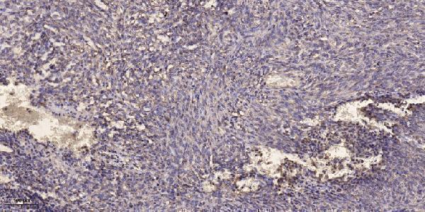 Immunohistochemical analysis of paraffin-embedded human Colon cancer