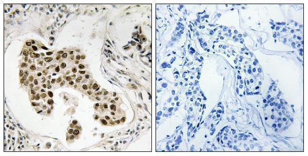 Immunohistochemistry analysis of paraffin-embedded human breast carcinoma, using PMS2/PMS2CL Antibody