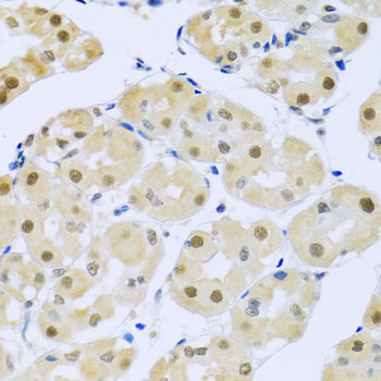 Immunohistochemistry of paraffin-embedded human esophageal cancer using SMEK1 Rabbit pAb  at dilution of 1:100 