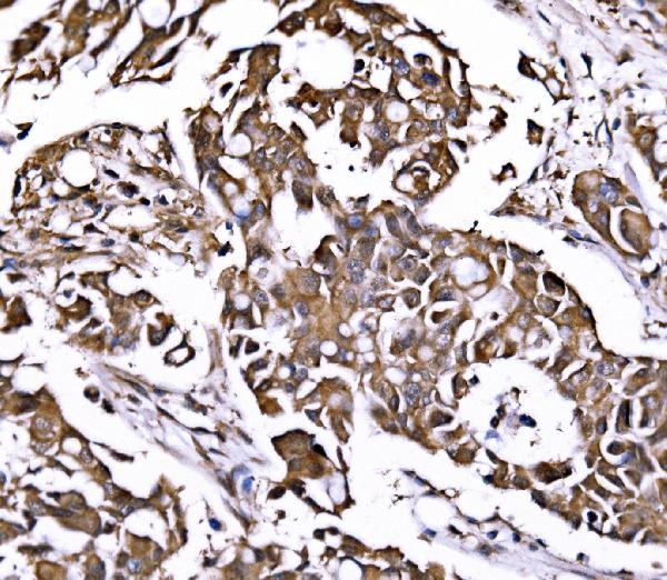 Figure 4. IHC analysis of PSMD8 using anti-PSMD8 antibody (A12465-1). PSMD8 was detected in a paraffin-embedded section of human breast cancer tissue. Heat mediated antigen retrieval was performed in EDTA buffer (pH 8.0, epitope retrieval solution). The tissue section was blocked with 10% goat serum. The tissue section was then incubated with 2 microg/ml rabbit anti-PSMD8 Antibody (A12465-1) overnight at 4°C. Biotinylated goat anti-rabbit IgG was used as secondary antibody and incubated for 30 minutes at 37°C. The tissue section was developed using Strepavidin-Biotin-Complex (SABC) (Catalog # SA1022) with DAB as the chromogen.