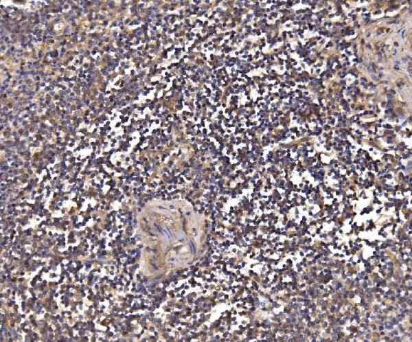 Figure 5. IHC analysis of PSMD8 using anti-PSMD8 antibody (A12465-1). PSMD8 was detected in a paraffin-embedded section of human lienal pupture tissue. Heat mediated antigen retrieval was performed in EDTA buffer (pH 8.0, epitope retrieval solution). The tissue section was blocked with 10% goat serum. The tissue section was then incubated with 2 microg/ml rabbit anti-PSMD8 Antibody (A12465-1) overnight at 4°C. Biotinylated goat anti-rabbit IgG was used as secondary antibody and incubated for 30 minutes at 37°C. The tissue section was developed using Strepavidin-Biotin-Complex (SABC) (Catalog # SA1022) with DAB as the chromogen.