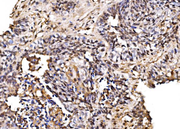 Figure 6. IHC analysis of PSMD8 using anti-PSMD8 antibody (A12465-1). PSMD8 was detected in a paraffin-embedded section of human lung cancer tissue. Heat mediated antigen retrieval was performed in EDTA buffer (pH 8.0, epitope retrieval solution). The tissue section was blocked with 10% goat serum. The tissue section was then incubated with 2 microg/ml rabbit anti-PSMD8 Antibody (A12465-1) overnight at 4°C. Biotinylated goat anti-rabbit IgG was used as secondary antibody and incubated for 30 minutes at 37°C. The tissue section was developed using Strepavidin-Biotin-Complex (SABC) (Catalog # SA1022) with DAB as the chromogen.