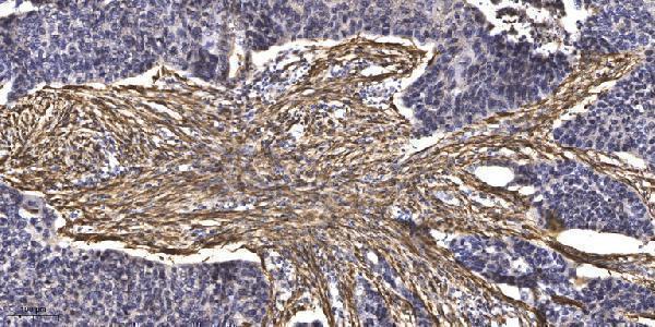 Immunohistochemical analysis of paraffin-embedded human Squamous cell carcinoma of lung