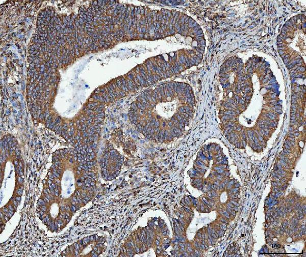 Figure 2. IHC analysis of TRMT61B using anti-TRMT61B antibody (A12682-2). TRMT61B was detected in a paraffin-embedded section of human colorectal adenocarcinoma tissue. Heat mediated antigen retrieval was performed in EDTA buffer (pH 8.0, epitope retrieval solution). The tissue section was blocked with 10% goat serum. The tissue section was then incubated with 2 microg/ml rabbit anti-TRMT61B Antibody (A12682-2) overnight at 4°C. Peroxidase Conjugated Goat Anti-rabbit IgG was used as secondary antibody and incubated for 30 minutes at 37°C. The tissue section was developed using HRP Conjugated Rabbit IgG Super Vision Assay Kit (Catalog # SV0002) with DAB as the chromogen. Figure 2. IHC analysis of TRMT61B using anti-TRMT61B antibody (A12682-2). TRMT61B was detected in a paraffin-embedded section of human colorectal adenocarcinoma tissue. Heat mediated antigen retrieval was performed in EDTA buffer (pH 8.0, epitope retrieval solution). The tissue section was blocked with 10% goat serum. The tissue section was then incubated with 2 microg/ml rabbit anti-TRMT61B Antibody (A12682-2) overnight at 4°C. Peroxidase Conjugated Goat Anti-rabbit IgG was used as secondary antibody and incubated for 30 minutes at 37°C. The tissue section was developed using HRP Conjugated Rabbit IgG Super Vision Assay Kit (Catalog # SV0002) with DAB as the chromogen.