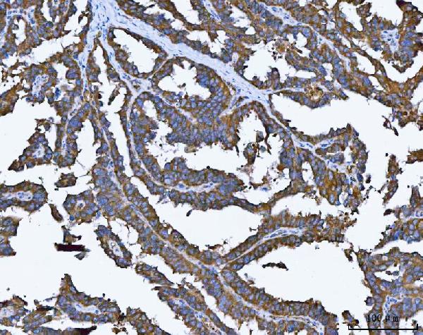 Figure 4. IHC analysis of TRMT61B using anti-TRMT61B antibody (A12682-2). TRMT61B was detected in a paraffin-embedded section of human ovarian cancer tissue. Heat mediated antigen retrieval was performed in EDTA buffer (pH 8.0, epitope retrieval solution). The tissue section was blocked with 10% goat serum. The tissue section was then incubated with 2 microg/ml rabbit anti-TRMT61B Antibody (A12682-2) overnight at 4°C. Peroxidase Conjugated Goat Anti-rabbit IgG was used as secondary antibody and incubated for 30 minutes at 37°C. The tissue section was developed using HRP Conjugated Rabbit IgG Super Vision Assay Kit (Catalog # SV0002) with DAB as the chromogen. Figure 4. IHC analysis of TRMT61B using anti-TRMT61B antibody (A12682-2). TRMT61B was detected in a paraffin-embedded section of human ovarian cancer tissue. Heat mediated antigen retrieval was performed in EDTA buffer (pH 8.0, epitope retrieval solution). The tissue section was blocked with 10% goat serum. The tissue section was then incubated with 2 microg/ml rabbit anti-TRMT61B Antibody (A12682-2) overnight at 4°C. Peroxidase Conjugated Goat Anti-rabbit IgG was used as secondary antibody and incubated for 30 minutes at 37°C. The tissue section was developed using HRP Conjugated Rabbit IgG Super Vision Assay Kit (Catalog # SV0002) with DAB as the chromogen.