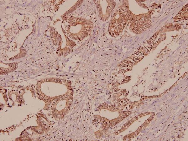 Immunohistochemistry (IHC) analyzes of Galectin-7 (Q67) pAb in paraffin-embedded human colorectal carcinoma tissue at 1:50