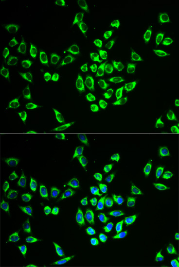 Immunohistochemistry of paraffin-embedded human lung cancer using MRPL28 antibody  at dilution of 1:100 