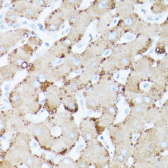 Immunohistochemistry of paraffin-embedded human liver cancer using HSD17B13 Rabbit pAb  at dilution of 1:100 
