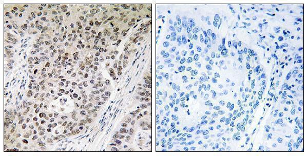Immunohistochemistry analysis of paraffin-embedded human lung carcinoma tissue, using ZNF608 Antibody