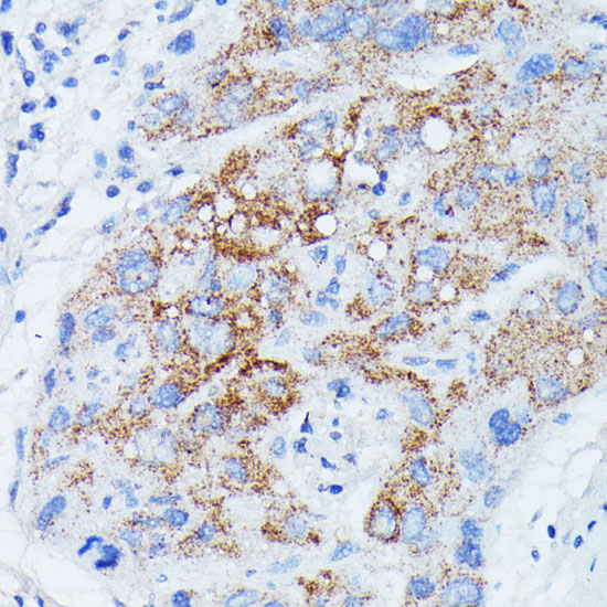 Immunohistochemistry of paraffin-embedded human liver cancer using MANBA antibody  at dilution of 1:100 