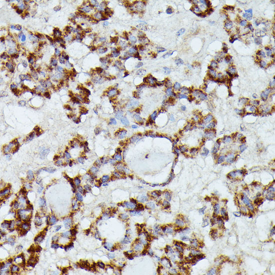 Immunohistochemistry of paraffin-embedded human thyroid cancer using MANBA antibody  at dilution of 1:100 