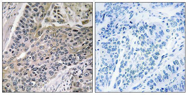 Immunohistochemistry analysis of paraffin-embedded human lung carcinoma tissue, using MRPS7 Antibody