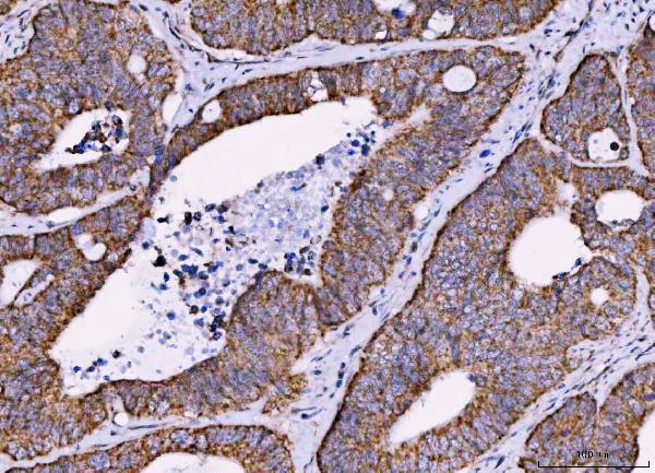 Figure 3. IHC analysis of MRPS18B using anti-MRPS18B antibody (A12773-1). MRPS18B was detected in a paraffin-embedded section of human colorectal adenocarcinoma tissue. Heat mediated antigen retrieval was performed in EDTA buffer (pH 8.0, epitope retrieval solution). The tissue section was blocked with 10% goat serum. The tissue section was then incubated with 2 microg/ml rabbit anti-MRPS18B Antibody (A12773-1) overnight at 4°C. Peroxidase Conjugated Goat Anti-rabbit IgG was used as secondary antibody and incubated for 30 minutes at 37°C. The tissue section was developed using HRP Conjugated Rabbit IgG Super Vision Assay Kit (Catalog # SV0002) with DAB as the chromogen.