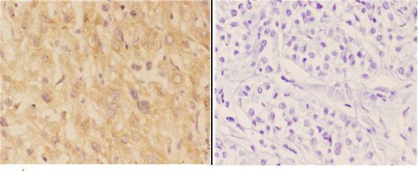 Immunohistochemistry (IHC) analyzes of ACER1 pAb bin paraffin-embedded human liver carcinoma tissue at 1:50,showing cytoplasmic staining