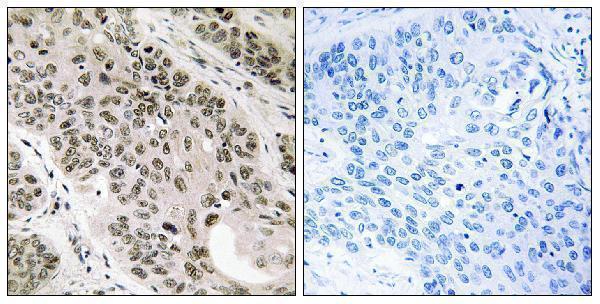 Immunohistochemistry analysis of paraffin-embedded human lung carcinoma tissue, using TNNI3K Antibody