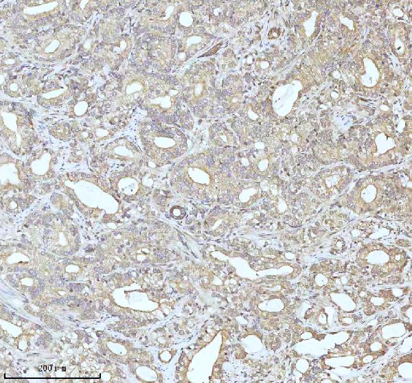 Figure 10. IHC analysis of C7orf30/MALSU1 using anti-C7orf30/MALSU1 antibody (A12786). C7orf30/MALSU1 was detected in a paraffin-embedded section of human prostate adenocarcinoma tissue. Heat mediated antigen retrieval was performed in EDTA buffer (pH 8.0, epitope retrieval solution). The tissue section was blocked with 10% goat serum. The tissue section was then incubated with 2 microg/ml rabbit anti-C7orf30/MALSU1 Antibody (A12786) overnight at 4°C. Peroxidase Conjugated Goat Anti-rabbit IgG was used as secondary antibody and incubated for 30 minutes at 37°C. The tissue section was developed using HRP Conjugated Rabbit IgG Super Vision Assay Kit (Catalog # SV0002) with DAB as the chromogen. Figure 10. IHC analysis of C7orf30/MALSU1 using anti-C7orf30/MALSU1 antibody (A12786). C7orf30/MALSU1 was detected in a paraffin-embedded section of human prostate adenocarcinoma tissue. Heat mediated antigen retrieval was performed in EDTA buffer (pH 8.0, epitope retrieval solution). The tissue section was blocked with 10% goat serum. The tissue section was then incubated with 2 microg/ml rabbit anti-C7orf30/MALSU1 Antibody (A12786) overnight at 4°C. Peroxidase Conjugated Goat Anti-rabbit IgG was used as secondary antibody and incubated for 30 minutes at 37°C. The tissue section was developed using HRP Conjugated Rabbit IgG Super Vision Assay Kit (Catalog # SV0002) with DAB as the chromogen.
