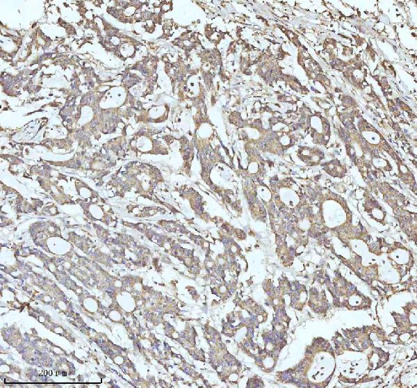 Figure 2. IHC analysis of C7orf30/MALSU1 using anti-C7orf30/MALSU1 antibody (A12786). C7orf30/MALSU1 was detected in a paraffin-embedded section of human colon adenocarcinoma tissue. Heat mediated antigen retrieval was performed in EDTA buffer (pH 8.0, epitope retrieval solution). The tissue section was blocked with 10% goat serum. The tissue section was then incubated with 2 microg/ml rabbit anti-C7orf30/MALSU1 Antibody (A12786) overnight at 4°C. Peroxidase Conjugated Goat Anti-rabbit IgG was used as secondary antibody and incubated for 30 minutes at 37°C. The tissue section was developed using HRP Conjugated Rabbit IgG Super Vision Assay Kit (Catalog # SV0002) with DAB as the chromogen. Figure 2. IHC analysis of C7orf30/MALSU1 using anti-C7orf30/MALSU1 antibody (A12786). C7orf30/MALSU1 was detected in a paraffin-embedded section of human colon adenocarcinoma tissue. Heat mediated antigen retrieval was performed in EDTA buffer (pH 8.0, epitope retrieval solution). The tissue section was blocked with 10% goat serum. The tissue section was then incubated with 2 microg/ml rabbit anti-C7orf30/MALSU1 Antibody (A12786) overnight at 4°C. Peroxidase Conjugated Goat Anti-rabbit IgG was used as secondary antibody and incubated for 30 minutes at 37°C. The tissue section was developed using HRP Conjugated Rabbit IgG Super Vision Assay Kit (Catalog # SV0002) with DAB as the chromogen.