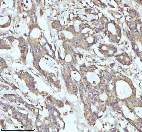 Figure 3. IHC analysis of C7orf30/MALSU1 using anti-C7orf30/MALSU1 antibody (A12786). C7orf30/MALSU1 was detected in a paraffin-embedded section of human colon adenocarcinoma tissue. Heat mediated antigen retrieval was performed in EDTA buffer (pH 8.0, epitope retrieval solution). The tissue section was blocked with 10% goat serum. The tissue section was then incubated with 2 microg/ml rabbit anti-C7orf30/MALSU1 Antibody (A12786) overnight at 4°C. Peroxidase Conjugated Goat Anti-rabbit IgG was used as secondary antibody and incubated for 30 minutes at 37°C. The tissue section was developed using HRP Conjugated Rabbit IgG Super Vision Assay Kit (Catalog # SV0002) with DAB as the chromogen. Figure 3. IHC analysis of C7orf30/MALSU1 using anti-C7orf30/MALSU1 antibody (A12786). C7orf30/MALSU1 was detected in a paraffin-embedded section of human colon adenocarcinoma tissue. Heat mediated antigen retrieval was performed in EDTA buffer (pH 8.0, epitope retrieval solution). The tissue section was blocked with 10% goat serum. The tissue section was then incubated with 2 microg/ml rabbit anti-C7orf30/MALSU1 Antibody (A12786) overnight at 4°C. Peroxidase Conjugated Goat Anti-rabbit IgG was used as secondary antibody and incubated for 30 minutes at 37°C. The tissue section was developed using HRP Conjugated Rabbit IgG Super Vision Assay Kit (Catalog # SV0002) with DAB as the chromogen.