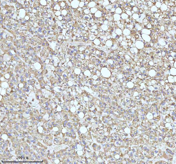 Figure 4. IHC analysis of C7orf30/MALSU1 using anti-C7orf30/MALSU1 antibody (A12786). C7orf30/MALSU1 was detected in a paraffin-embedded section of human liver cancer tissue. Heat mediated antigen retrieval was performed in EDTA buffer (pH 8.0, epitope retrieval solution). The tissue section was blocked with 10% goat serum. The tissue section was then incubated with 2 microg/ml rabbit anti-C7orf30/MALSU1 Antibody (A12786) overnight at 4°C. Peroxidase Conjugated Goat Anti-rabbit IgG was used as secondary antibody and incubated for 30 minutes at 37°C. The tissue section was developed using HRP Conjugated Rabbit IgG Super Vision Assay Kit (Catalog # SV0002) with DAB as the chromogen. Figure 4. IHC analysis of C7orf30/MALSU1 using anti-C7orf30/MALSU1 antibody (A12786). C7orf30/MALSU1 was detected in a paraffin-embedded section of human liver cancer tissue. Heat mediated antigen retrieval was performed in EDTA buffer (pH 8.0, epitope retrieval solution). The tissue section was blocked with 10% goat serum. The tissue section was then incubated with 2 microg/ml rabbit anti-C7orf30/MALSU1 Antibody (A12786) overnight at 4°C. Peroxidase Conjugated Goat Anti-rabbit IgG was used as secondary antibody and incubated for 30 minutes at 37°C. The tissue section was developed using HRP Conjugated Rabbit IgG Super Vision Assay Kit (Catalog # SV0002) with DAB as the chromogen.