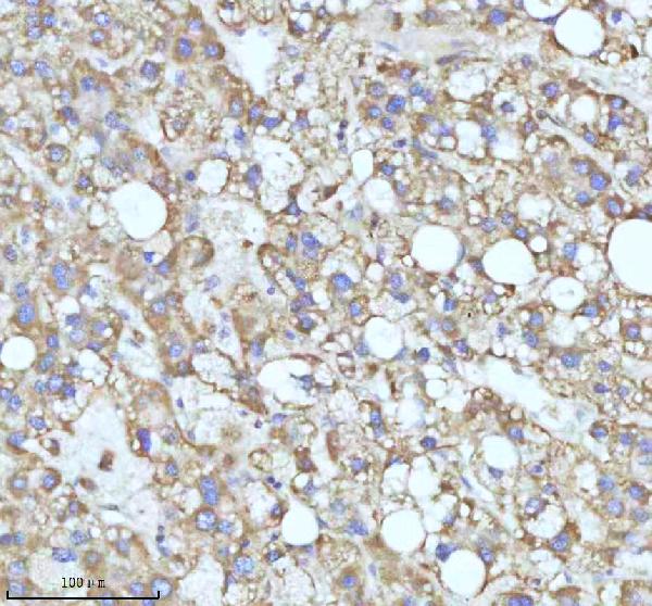 Figure 5. IHC analysis of C7orf30/MALSU1 using anti-C7orf30/MALSU1 antibody (A12786). C7orf30/MALSU1 was detected in a paraffin-embedded section of human liver cancer tissue. Heat mediated antigen retrieval was performed in EDTA buffer (pH 8.0, epitope retrieval solution). The tissue section was blocked with 10% goat serum. The tissue section was then incubated with 2 microg/ml rabbit anti-C7orf30/MALSU1 Antibody (A12786) overnight at 4°C. Peroxidase Conjugated Goat Anti-rabbit IgG was used as secondary antibody and incubated for 30 minutes at 37°C. The tissue section was developed using HRP Conjugated Rabbit IgG Super Vision Assay Kit (Catalog # SV0002) with DAB as the chromogen. Figure 5. IHC analysis of C7orf30/MALSU1 using anti-C7orf30/MALSU1 antibody (A12786). C7orf30/MALSU1 was detected in a paraffin-embedded section of human liver cancer tissue. Heat mediated antigen retrieval was performed in EDTA buffer (pH 8.0, epitope retrieval solution). The tissue section was blocked with 10% goat serum. The tissue section was then incubated with 2 microg/ml rabbit anti-C7orf30/MALSU1 Antibody (A12786) overnight at 4°C. Peroxidase Conjugated Goat Anti-rabbit IgG was used as secondary antibody and incubated for 30 minutes at 37°C. The tissue section was developed using HRP Conjugated Rabbit IgG Super Vision Assay Kit (Catalog # SV0002) with DAB as the chromogen.