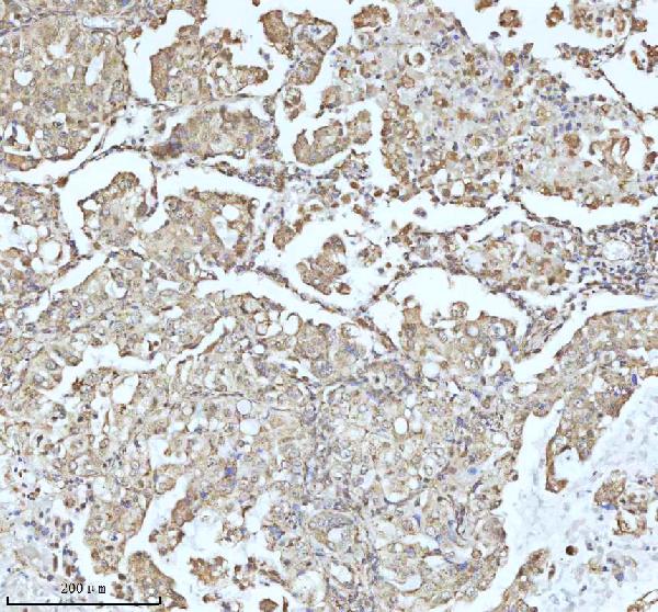 Figure 6. IHC analysis of C7orf30/MALSU1 using anti-C7orf30/MALSU1 antibody (A12786). C7orf30/MALSU1 was detected in a paraffin-embedded section of human lung adenocarcinoma tissue. Heat mediated antigen retrieval was performed in EDTA buffer (pH 8.0, epitope retrieval solution). The tissue section was blocked with 10% goat serum. The tissue section was then incubated with 2 microg/ml rabbit anti-C7orf30/MALSU1 Antibody (A12786) overnight at 4°C. Peroxidase Conjugated Goat Anti-rabbit IgG was used as secondary antibody and incubated for 30 minutes at 37°C. The tissue section was developed using HRP Conjugated Rabbit IgG Super Vision Assay Kit (Catalog # SV0002) with DAB as the chromogen. Figure 6. IHC analysis of C7orf30/MALSU1 using anti-C7orf30/MALSU1 antibody (A12786). C7orf30/MALSU1 was detected in a paraffin-embedded section of human lung adenocarcinoma tissue. Heat mediated antigen retrieval was performed in EDTA buffer (pH 8.0, epitope retrieval solution). The tissue section was blocked with 10% goat serum. The tissue section was then incubated with 2 microg/ml rabbit anti-C7orf30/MALSU1 Antibody (A12786) overnight at 4°C. Peroxidase Conjugated Goat Anti-rabbit IgG was used as secondary antibody and incubated for 30 minutes at 37°C. The tissue section was developed using HRP Conjugated Rabbit IgG Super Vision Assay Kit (Catalog # SV0002) with DAB as the chromogen.