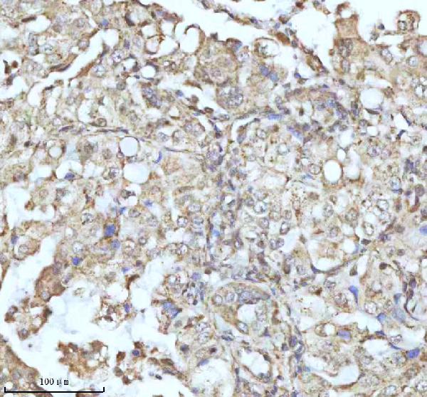 Figure 7. IHC analysis of C7orf30/MALSU1 using anti-C7orf30/MALSU1 antibody (A12786). C7orf30/MALSU1 was detected in a paraffin-embedded section of human lung adenocarcinoma tissue. Heat mediated antigen retrieval was performed in EDTA buffer (pH 8.0, epitope retrieval solution). The tissue section was blocked with 10% goat serum. The tissue section was then incubated with 2 microg/ml rabbit anti-C7orf30/MALSU1 Antibody (A12786) overnight at 4°C. Peroxidase Conjugated Goat Anti-rabbit IgG was used as secondary antibody and incubated for 30 minutes at 37°C. The tissue section was developed using HRP Conjugated Rabbit IgG Super Vision Assay Kit (Catalog # SV0002) with DAB as the chromogen. Figure 7. IHC analysis of C7orf30/MALSU1 using anti-C7orf30/MALSU1 antibody (A12786). C7orf30/MALSU1 was detected in a paraffin-embedded section of human lung adenocarcinoma tissue. Heat mediated antigen retrieval was performed in EDTA buffer (pH 8.0, epitope retrieval solution). The tissue section was blocked with 10% goat serum. The tissue section was then incubated with 2 microg/ml rabbit anti-C7orf30/MALSU1 Antibody (A12786) overnight at 4°C. Peroxidase Conjugated Goat Anti-rabbit IgG was used as secondary antibody and incubated for 30 minutes at 37°C. The tissue section was developed using HRP Conjugated Rabbit IgG Super Vision Assay Kit (Catalog # SV0002) with DAB as the chromogen.