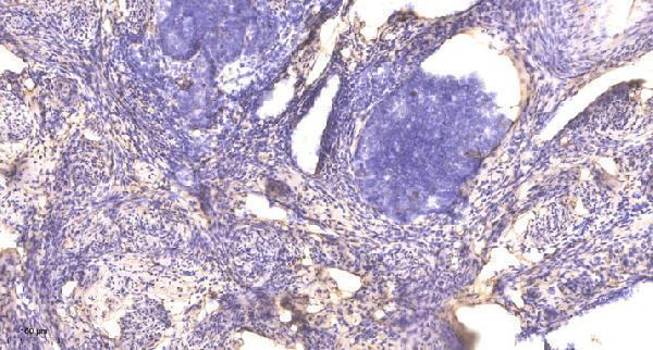 Immunohistochemical analysis of paraffin-embedded human cervical carcinoma