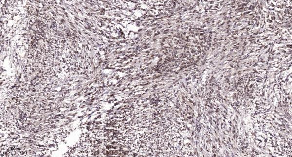 Immunohistochemical analysis of paraffin-embedded human Colon cancer
